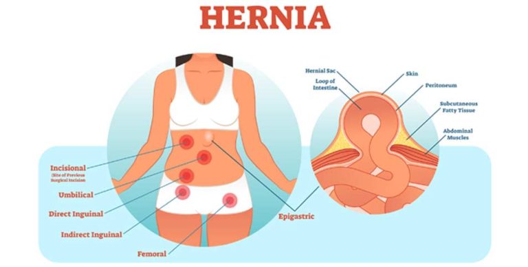 Can A Hernia Cause Weight Loss?